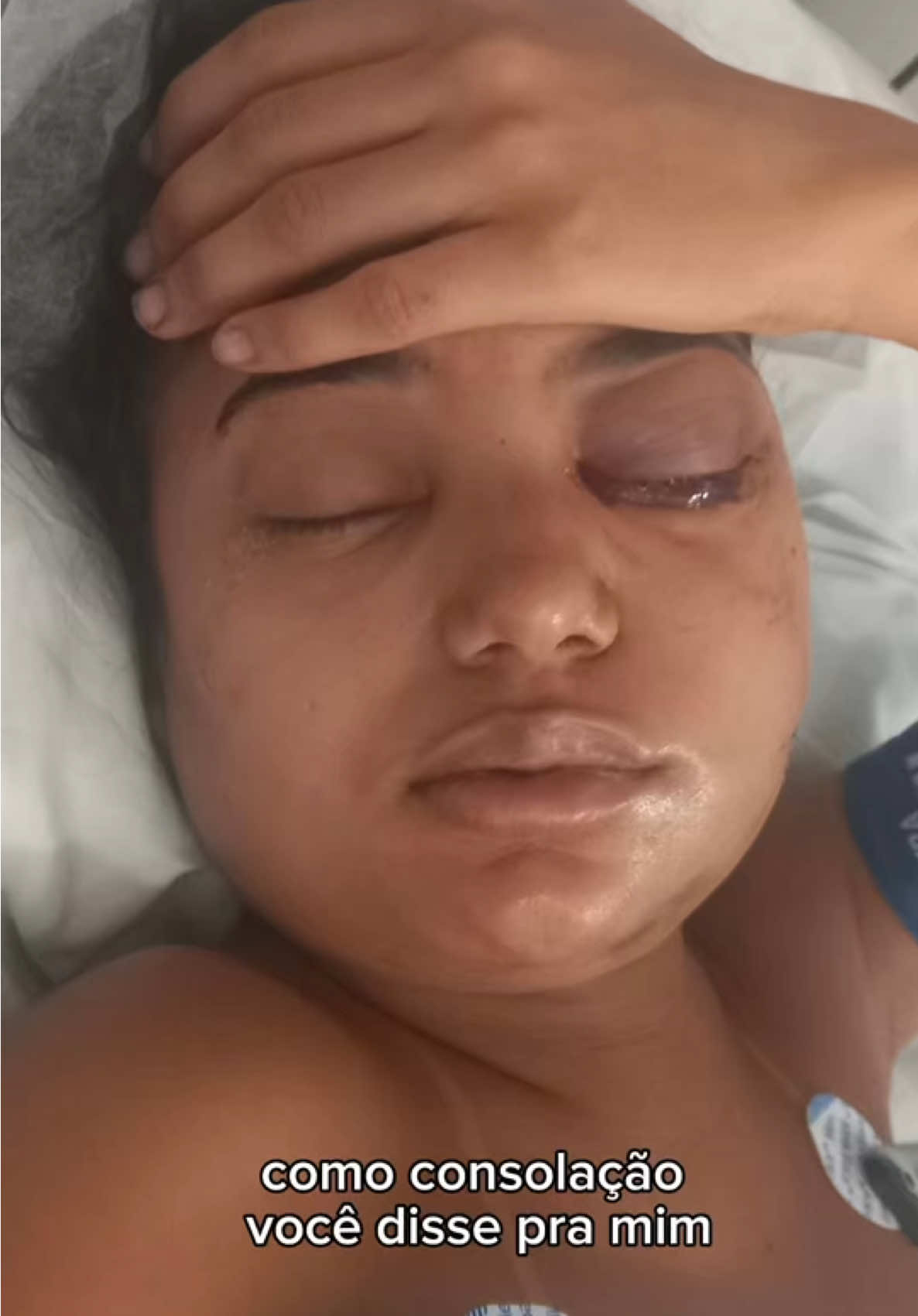 Hoje faz 5 meses do meu renascimento. Nem todo recomeço vem com festa… às vezes, ele vem com dor, com cicatriz e com muitas lágrimas escondidas. Mas ainda assim… é um recomeço. 🌱 #fy #fyp #proteseocular #graudemoto #mulherdepreso🔓🕊👫💍 