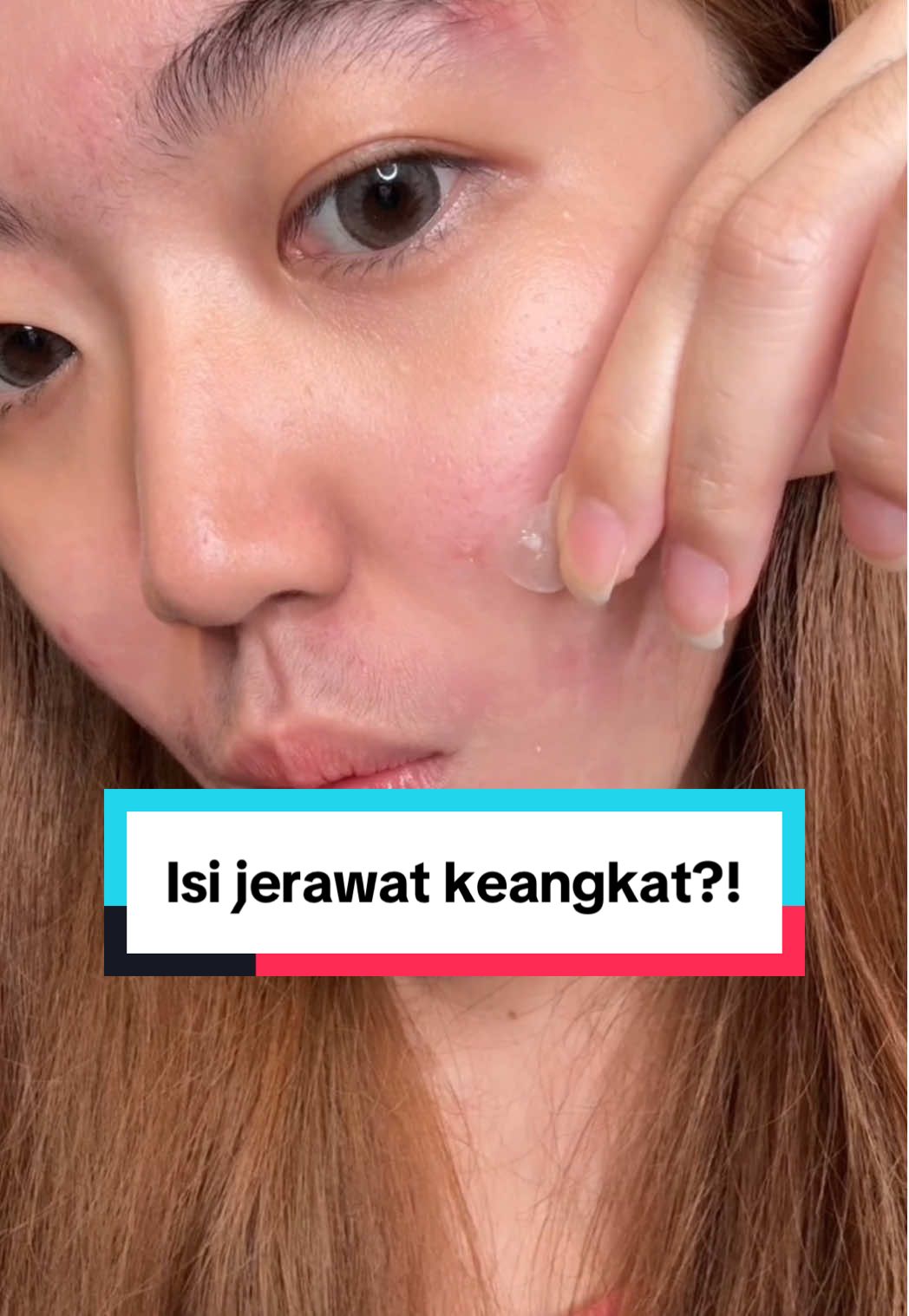 Muncul jerawat dadakan? Wajib punya acne patch satu ini di rumah! 😍✨ ada kandungan sulfurnya jadi bisa bantu meredakan jerawat! #acnepatch #acne #jerawat #acneproneskin #skincare 