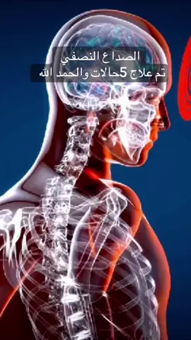 علاج الصداع النصفي بالحجامه ولله الحمد #حجامه #infoburst #علاج_طبيعي #صداع_نصفي #سائد_ابومريم #شقيقه 