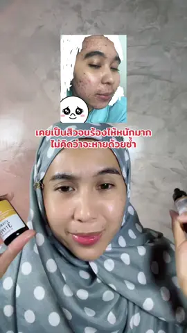 #เซรั่มวิตซี #gravich #เซรั่มกราวิช #เซรั่มวิตามินซี #รีวิว #รีวิวของดีบอกต่อ 