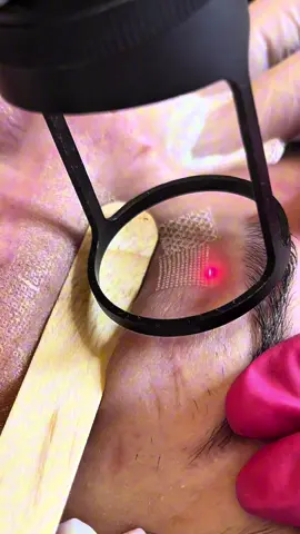 Diga adeus à flacidez palpebral! ✨  O Hybrid CO2 contrai a pele e redefine o contorno dos seus olhos. A retração da pele é real e incrível!  Um olhar renovado, rejuvenescido, suavizando flacidez com precisão. 💫