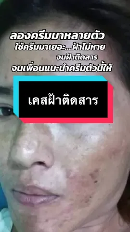 #ครีมปราบฝ้า ครีมหน้าใส #ฝ้ากระจุดด่างดํา #ฝ้าหนาฝังลึก แนะนําตัวนี้เลยค่ะ #ครีมrcc #ของแท้ต้องมีบัตรตัวแทนเท่านั้น✓ 
