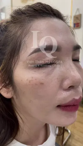 Cập Nhật Nám Đinh #chamsocdamun#chamsocdaseo#chamsocdanam#tanbinh#govap#Lequynh#Lqspa       