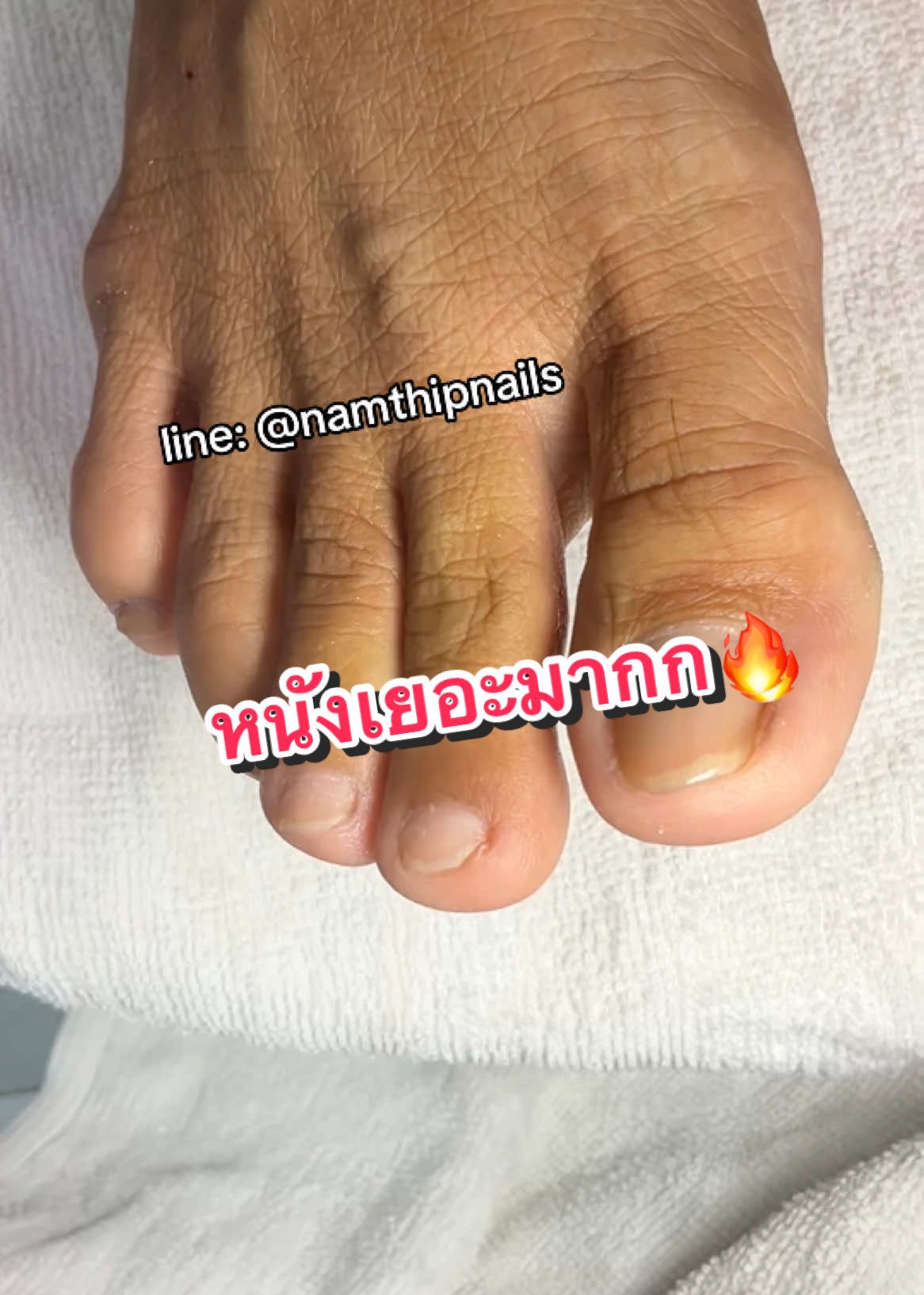 💓 #namthipnails #ตัดเล็บขบ #ตัดหนัง #ทำเล็บ #ร้านตัดเล็บขบ #ร้านตัดเล็บขบราม2 #ตัดเล็บ #เล็บขบ  #เล็บเชื้อรา Fb : namthipnails  Line : @namthipnails  นัมเบอร์วัน8 ตลาดม.ราม2  กทม  Map: namthipnails  https://goo.gl/maps/JmwpCKLfKwmhKGK96  ร้านเปิดทุกวัน เวลา12.00น-22.00น.