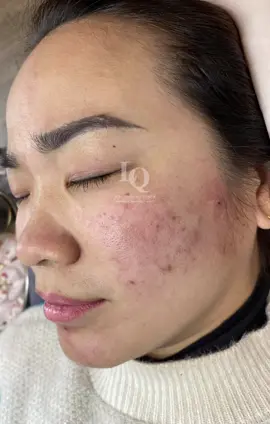 Cập nhật Da Mụn#chamsocdamun#chamsocdanam#chamsocdaseo#Lequynhspa#Hocnghespa#nanmunbangtay#nanmunbangtambong