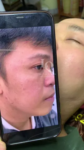 Cập Nhật Sẹo#chamsocdamun#chamsocdanam#chamsocseo#lequynhspa#hocnghespa#nanmunbangtambong#nanmunbangtay