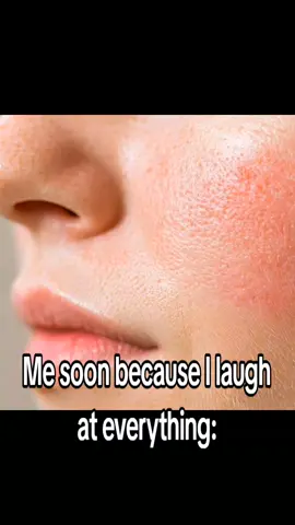 I don't hate smile lines or anything I just hate it when my resting face has a smile line or smth #fyp #foryoupage #unflopme #smilelines #relatable 