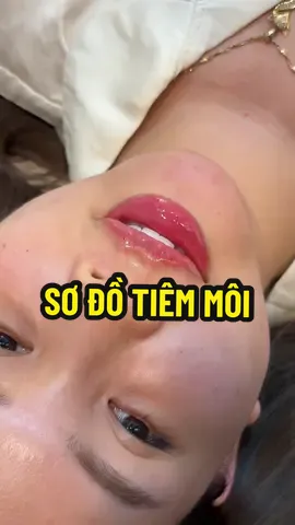 Làm răng thì tiêm dáng nào mấy níiii #xuhuong #nganle #tiemmoi 