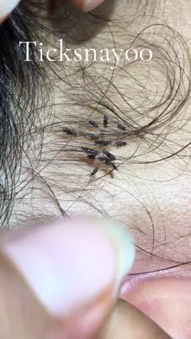 Remove lice #omg😱😱😱 #lice #lice😰😰😰 #tripofobia😮😥 #😂😂😂 #😰😨😭 #removelice #liceremoval 
