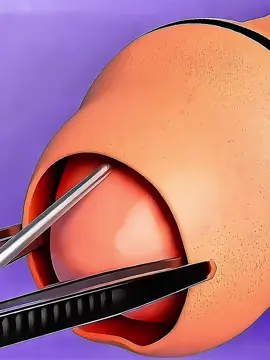 B Clamp Device For Circumcission Surgery ! #circumcision #circumcisionsurgery #menshealth #medicalanimation 
