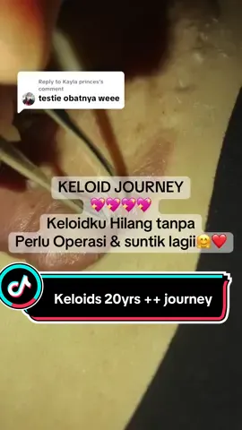 Replying to @Kayla princes selain sdh banyak testimoni dari customer, produk myscars kebetulan jg punya   background team yg semua adalah pejuang bekas luka dan keloid ya kakak💖🤗 banyak yg tdk percaya kalau sekarang sdh ada produk yg ampuh mengatasi bekas luka khusus nya keloid yg membandel, yes karena kami pun merasakan betapa sulitnya mengatasi keloid tdk hanya dengan obat, tp semua treatment bahkan operasi sdh kami lalui berkali kali.. memang kalau blm merasakan sendiri khasiat myscars akan sulit percaya dan its oke 💙👌 #obatkeloid #keloid #myscars #menghilangkankeloid #penghilangbekasluka #keloidhilang #keloidbekasluka #bekaslukahilang #obatkeloidampuh #menghilangkanbekasluka #pengalamankeloid #myscar #salepkeloid  