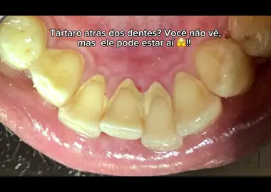 🚨O tártaro pode está atrás do seu dente, mesmo que você não o veja !!  Fique atento: Se você sente os seus dentes ásperos, mais amarelados, fio dental desfiando ou dificuldade de passar o fio dental, pode ser que esteja precisando de uma limpeza  mais profunda com seu dentista ( profilaxia ) 😉!!  Gostou do conteúdo ? Envia para aquela pessoa que você acha que pode estar precisando dessa dica 🙂!!  Se tem algum tempo que não vai ao dentista e está precisando de uma limpeza mais profunda nos seus dentes , entra em contato conosco 😃!! Contato no link da bio !! 