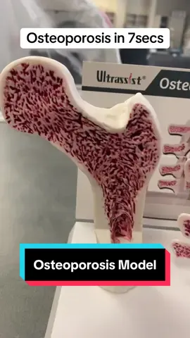 What is osteoporosis? Osteoporosis Model in 7secs! #bone #anatomy #osteoporosis #osteoporosismodel #professorkleinanatomy 