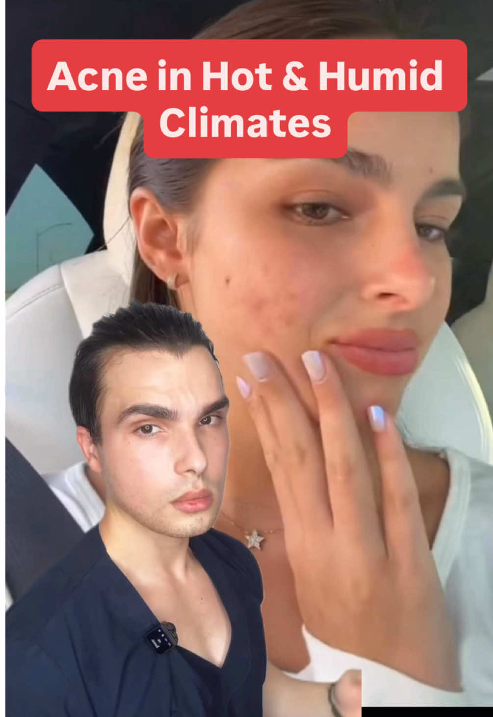 3 Essential Rules for Clear Skin in Humid Weather 1️⃣ Use an acne-fighting cleanser daily. 2️⃣ Spray hypochlorous acid throughout the day. 3️⃣ Avoid heavy creams; choose a lightweight, water-based moisturizer. #skincareroutines #skincareproducts #acneskincare #acnetips #hypochlorousacid 
