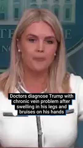 Donald Trump has been diagnosed with a chronic vein condition after he noticed swelling in his legs and was seen with bruises on his hands. The 79-year-old has been diagnosed with chronic venous insufficiency, the White House announced on Thursday. Reading from a note from Trump’s physician, Capt Sean Barbabella, Leavitt said there was ‘no evidence of deep vein thrombosis or arterial disease’. #us #donaldtrump #thewhitehouse