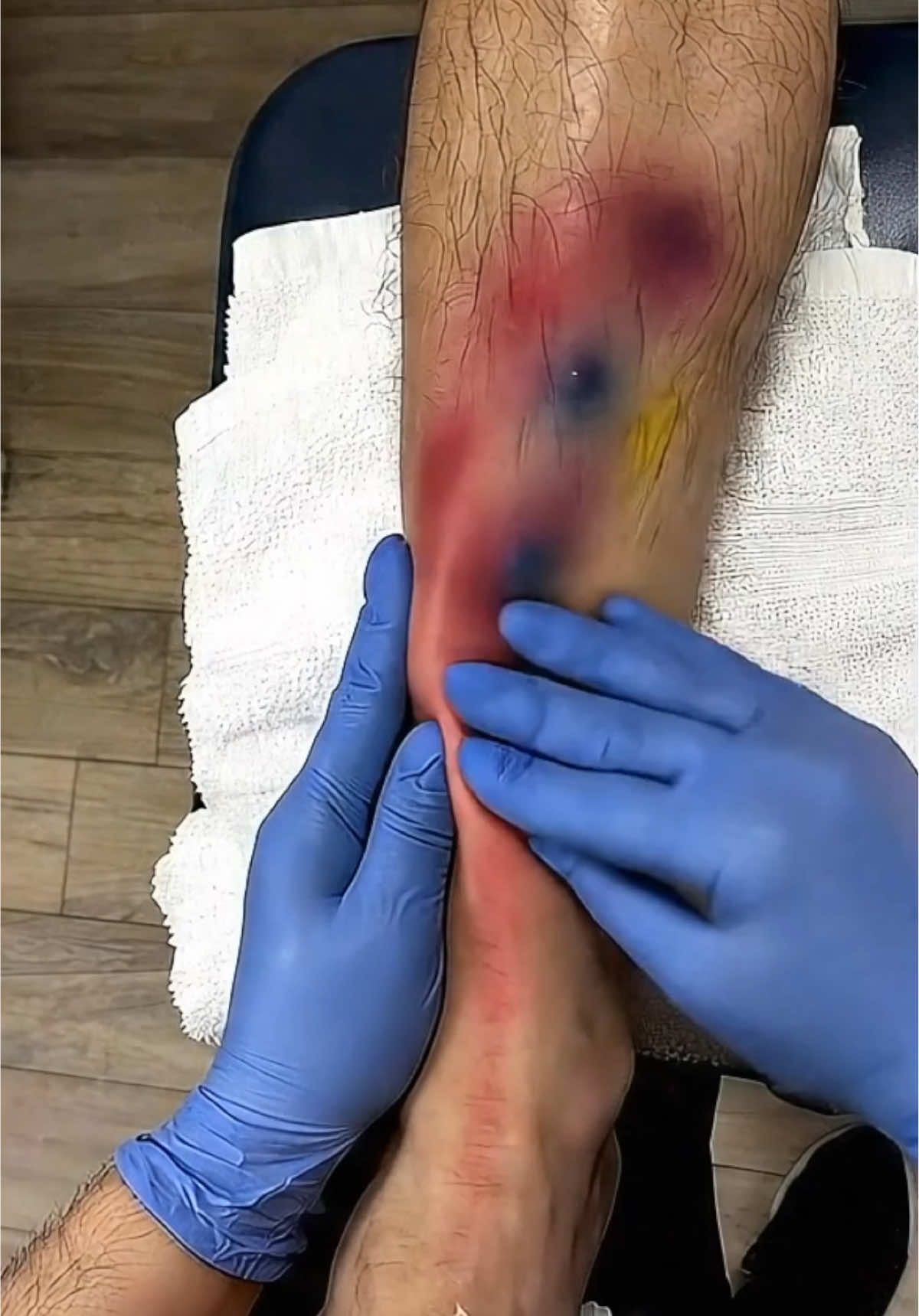 How to recover from injury? Scraping is a soft tissue technique used in physical therapy to reduce tightness and help muscles heal. It improves blood flow, breaks down scar tissue, and helps restore mobility — especially after injury or overuse. #rehabilitation #recovery #physicaltherapy #ai 