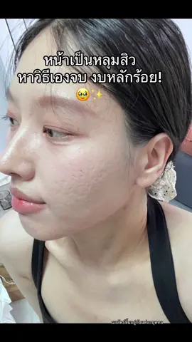เซรั่มหลุมสิวที่จริงใจ gravichยืน1 #ป้ายยาtiktok #หลุมสิวตื้นขึ้น #หลุมสิว #รูขุมขนกว้าง #หน้าใส #หน้าเนียนใส #ดันขึ้นฟีดที 