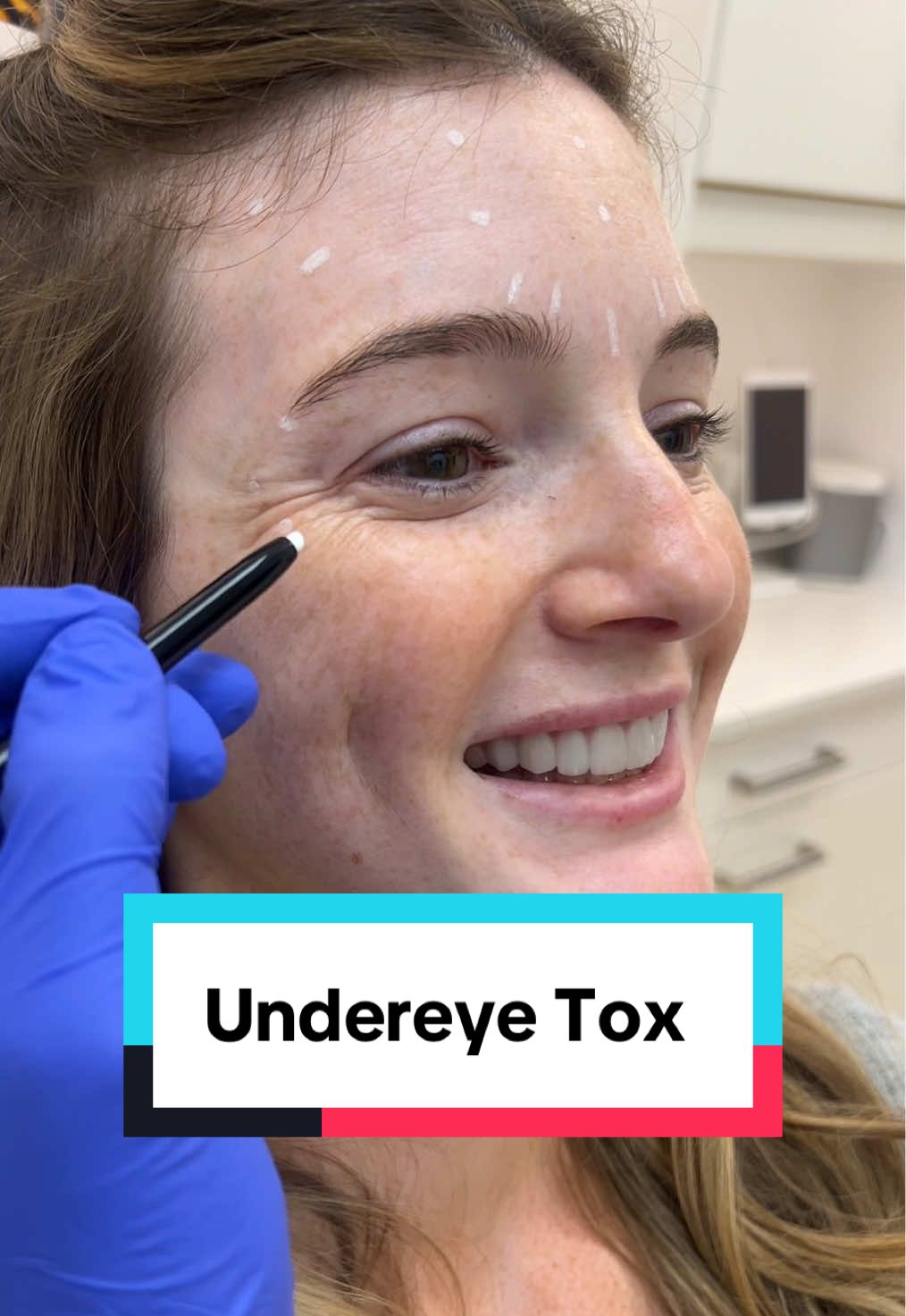 She is 10 months out from her wedding - and we are starting early to ensure she is GLOWING for the big day ✨ @Maddieboos  #asmr #bridetobe #facialmapping #unintentionalasmr #anticipatoryasmr #selfcareasmr #soothingvoice #calming #chicagoinjector #chicagobotox 