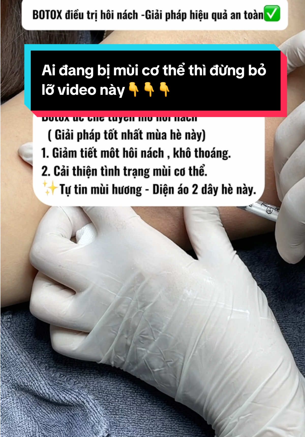 🎯 Lợi ích của tiêm Botox nách:     ✅Giảm tiết mồ hôi hiệu quả (giảm tới 80–90%)   ✅Giảm mùi hôi nách do giảm mồ hôi   ✅Không cần phẫu thuật, thực hiện nhanh (15–30 phút)   ✅Không ảnh hưởng đến hoạt động thể chất hằng ngày #noraskin #norapeel #mesotherapy #mesotherapy #nanmuntpbacninh #nanmuntpbacninh #nanmunchuanykhoa #chamsocda #ilovetiktok 