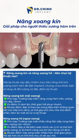 Bạn bị mất răng hàm trên nhưng xương hàm không đủ để cấy ghép implant? 💡 Đừng lo, kỹ thuật nâng xoang kín (sinus lift) có thể là giải pháp phù hợp dành cho bạn. Phục hồi ăn nhai – bảo tồn cấu trúc – hạn chế xâm lấn. — Missing upper molars and not enough bone for implant placement? 💡 The internal sinus lift technique might be your best option! Minimally invasive – functional recovery – long-term success. — 上颌后牙缺失、骨量不足？ 💡 试试上颌窦内提升术！ 微创恢复快，维持咀嚼功能，预防骨吸收。 — 🦷 Dr.Chinh Implant – Đồng hành cùng nụ cười của bạn 🌐 Website: https://drchinh-implant.com 📞 Tư vấn: +84 0911 767 109 🕒 Thời gian khám: Thứ 2 – Chủ nhật, 13:00 – 20:00 🎁 Miễn phí chụp phim và tư vấn kế hoạch điều trị ✅ We offer consultation and treatment in English – no language barrier. ✅ Ideal for expats and overseas Vietnamese seeking high-quality dental care in Vietnam. ✅ International-standard implant procedures with reasonable cost and transparent treatment plans. ✅ 我们提供中文咨询与治疗，无语言障碍 ✅ 欢迎在越南工作的外籍人士和华侨前来就诊 ✅ 国际标准种植牙服务，价格透明，性价比高 ⸻ #drchinhimplant #nhakhoa #cayghepimplant #foryou #fypシ゚viral 