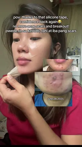 derma recommended kaya never ako naghesitate gamitin! #acnescar #siliconescar #siliconescarsheet #fyp 
