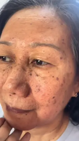 May melasma ka rin ba? Baka ito na ang sagot! Nasa yellow basket ko lang, check mo na! #fyp #foryou #foryoupage #melasma #melaglow #melaglowsoap 