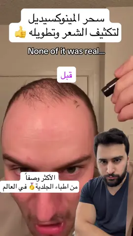 سحر المينوكسيديل للشعر وتكثيف الشعر 😍