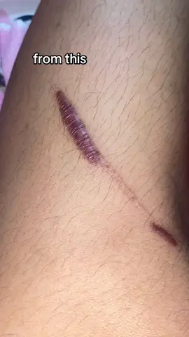 looking for scar remover? This is for you, silicone scar sheets for only 100+ pesos! Check out now and you will see the best result! ✨ #siliconesheetsforkeloids #siliconesheets #qusterepatxh #fyp