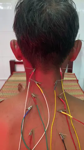 Bệnh nhân đau cổ vai gáy lâu ngày sau 1 lần điều trị bằng phương pháp điện châm kết hợp xoa bóp bấm huyệt giải cơ đã giảm đau cứng #chamcuu #xoabopbamhuyet #chamcuutainha #daucovaigay 