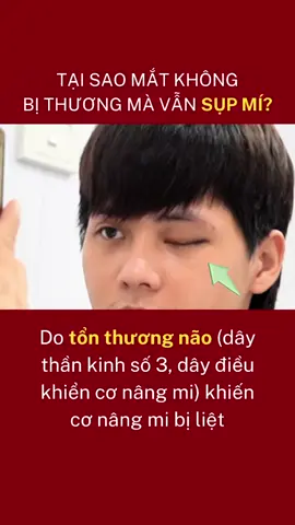 Tại sao ko bị thương mà mắt vẫn sụp?