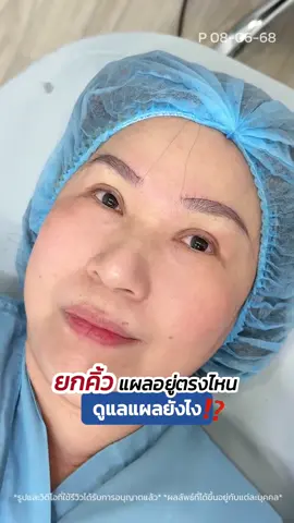 #ยกคิ้ว แก้คิ้วตก ‼️ แผลอยู่ตรงไหน ดูแลยังไง ✨ #รีวิวยกคิ้ว #directbrowlift #skyclinic #ศัลยกรรมตา #ทำตาที่ไหนดี #หมอสกาย #สกายคลินิก 