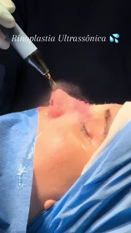 Um nariz de princesa💕 #rinoplastia #rinoplastiaultrassonica #princessnose 