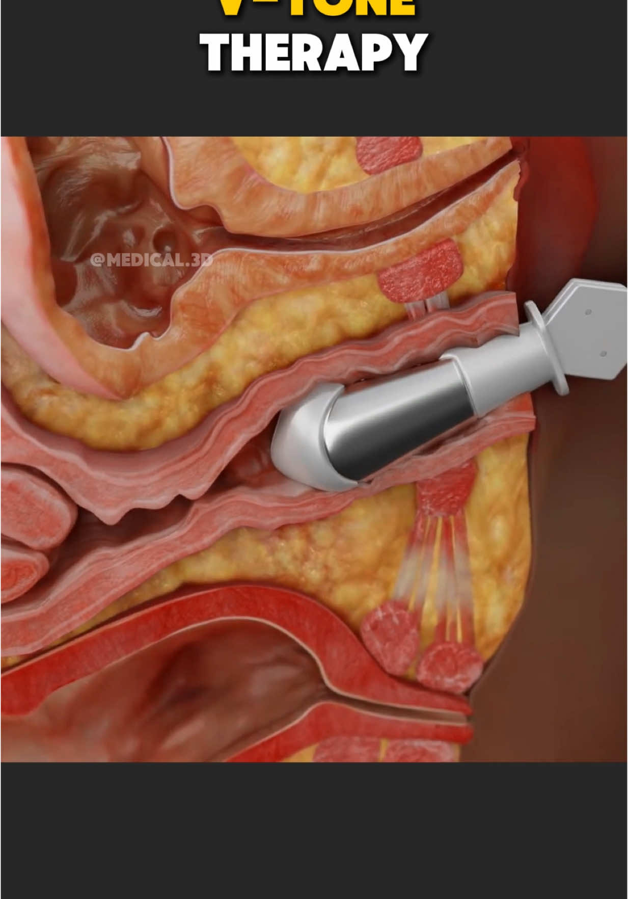 What is V-Tone Procedure and How It Works? (3D Animation) #vtonetreatment #vtonesurgery #rejuvination #tightening #musclestightening #pelvicfloor #vtoneinsertion #medical3danimation #3dmedicalanimation 