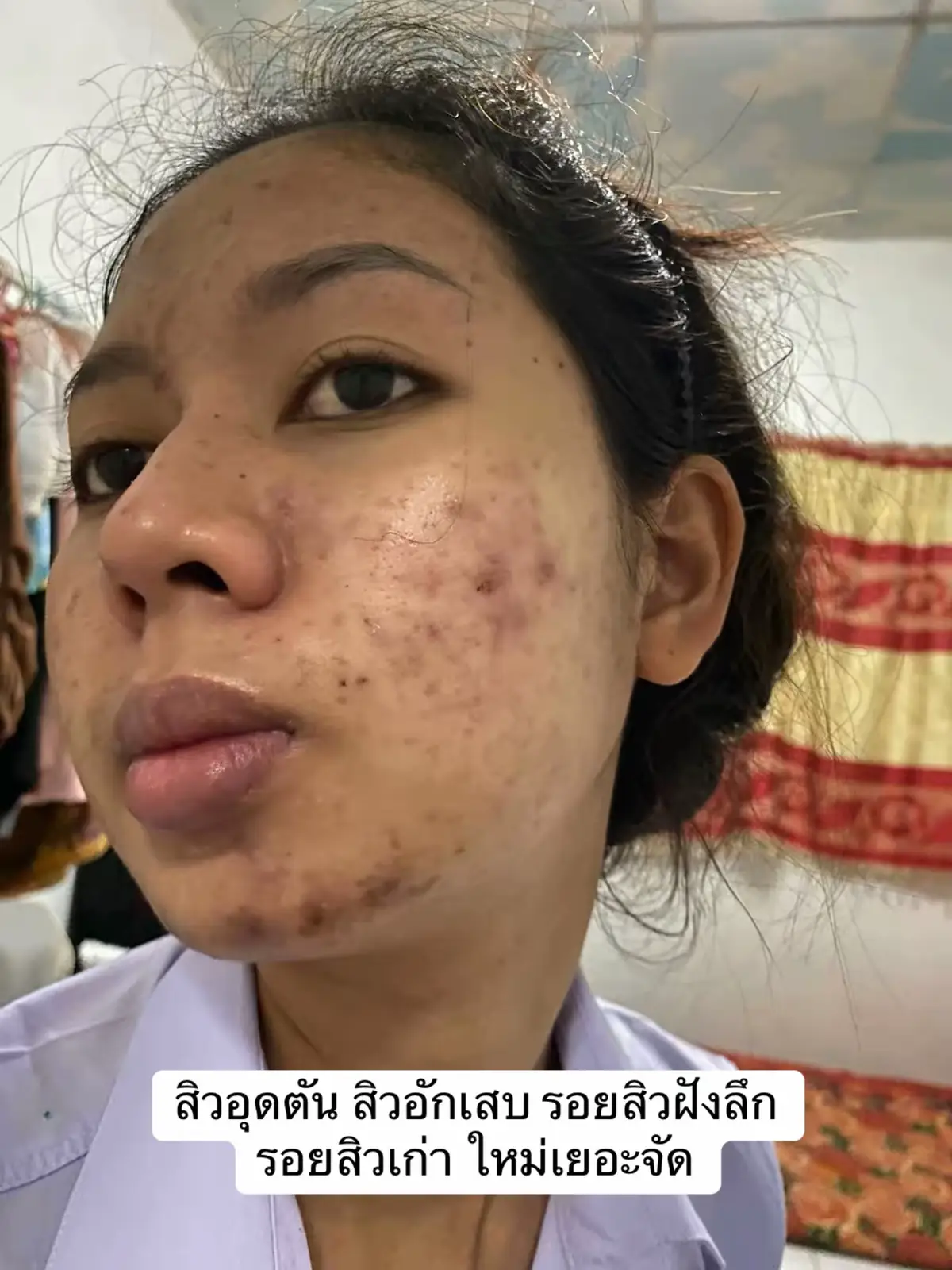 #สิว #รอยดําจากสิว #รอยแดงจากสิว #สกินแคร์ #ใช้ดีบอกต่อ #ป้ายยาสกินแคร์ #ป้ายยาtiktok #ส้มโอที่หน้าเป็นสิว #tiktok #tpyシforyou 