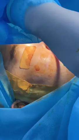 #xuhuong Nâng mũi 2025 cho Ce tham khảo #nângmui  #làmđẹp 