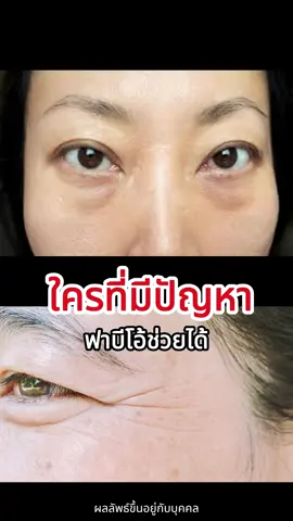 ฟาบีโอ้ช่วยได้  #ลองฟาบีโอ้ #Fabeothailand #Fabeo #ครีมนมผึ้งรกแกะ #ฝ้ากระ #สกินแคร์ #สกินแคร์ #โปรโมชั่น #ครีมตัวดัง #ลดฝ้ากระจุดด่างดำ 
