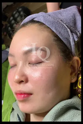 Cập nhật nám đinh#chamsocdamun#chamsocdanam#chamsocdaseo#Lequynhspa#Hocnghespa#nanmunbangtay#nanmunbangtambong