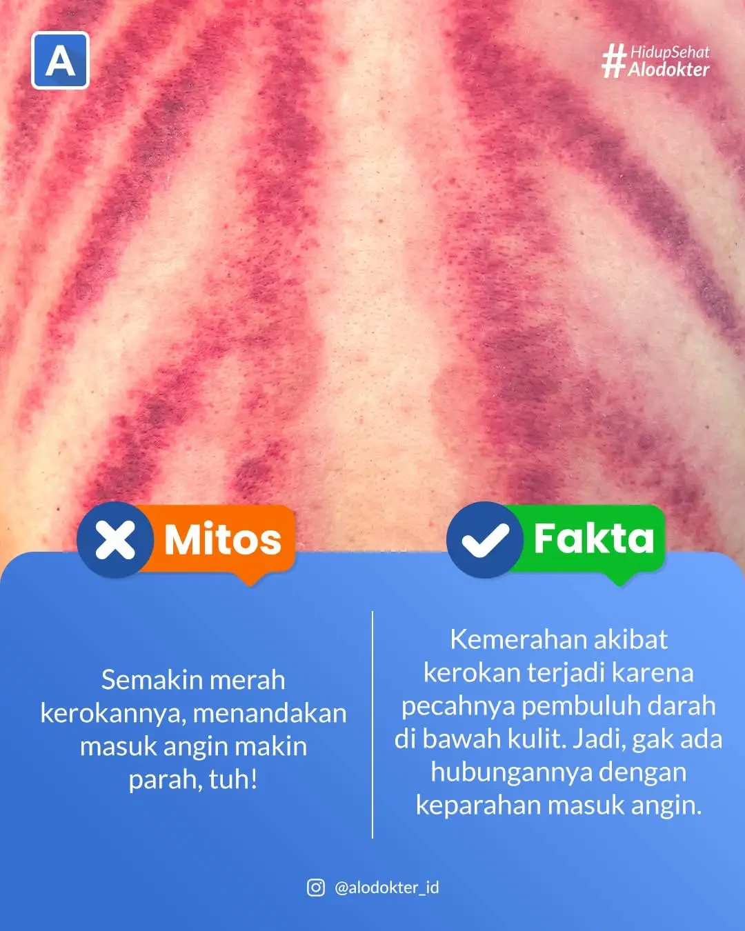 Siapa yang kalau merasa masuk angin langsung ambil koin dan minta dikerokin? Terus pas lihat hasilnyanya merah banget, langsung bilang, “Wah, masuk anginnya parah banget, nih!” Padahal, ini anggapan ini cuma mitos belaka ya.  Merah setelah kerokan bukanlah tanda parah atau ringannya masuk angin, tapi respons tubuh terhadap gesekan. Jadi gini, saat kulit digosok dengan alat kerokan, seperti koin, pembuluh darah kecil di bawah kulit bisa tertekan lalu pecah. Hasilnya: kulit jadi merah.  Semakin lama atau kuat kerokannya, kulit pun akan semakin merah. Jadi, makin merahnya kulit saat kerokan bukan karena masuk angin ya guys, tapi karena pecahnya pembuluh darah kecil di bawah kulit. Tapi kok abis kerokan badan terasa lebih enteng dan enakan ya? Ini bukan karena anginnya keluar lewat kerokan ya. Kerokan atau pijatan bisa merangsang produksi hormon endorfin, yaitu hormon penghilang rasa nyeri alami tubuh. Ini dia yang bikin kenapa badan jadi enakan abis dikerok kalau lagi masuk angin. Gimana, masih mau kerokan lagi? Aman, kok. Tapi, biar tetap sehat, coba ikutin tips-tips berikut ini yuk:  - Gunakan koin atau alat kerokan yang bersih  - Oleskan minyak gosok atau losion sebelumnya, biar kulit nggak iritasi atau luka  - Gosok perlahan, jangan terlalu kuat  - Gerakannya juga sebaiknya satu arah - Hindari kerokan di leher karena bisa memicu refleks vasovagal, yakni refleks yang berdampak pada jantung dan tekanan darah Selain kerokan, kamu juga bisa mencoba cara lain untuk mengatasi masuk angin, misalnya minum air jahe hangat, tidur yang cukup, atau minum obat pereda demam dan nyeri, seperti paracetamol. Tapi kalau keluhan nggak membaik atau malah muncul tanda seperti nyeri dada, mual muntah, demam tinggi, atau berkurangnya nafsu makan, sebaiknya konsultasikan ke dokter. #info #penting #infokesehatan #hidupsehat #dokter  #kerokan #MasukAngin #kesehatan #indonesia #fyp 