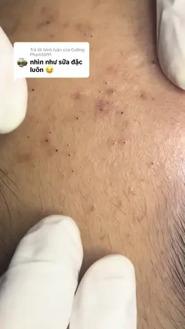 Trả lời @Cường Phạm5091 dùng gom mụn xong nặn phê luôn🥰#nặnmụntuyhoà #78 #phuyen #xuhuong 