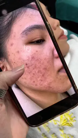 Cập nhật Mụn Thâm#chamsocdamun#chamsocdanam#chamsocseo#lequynhspa#nanmunbangtay#nanmunbangtambong#hocnghespa
