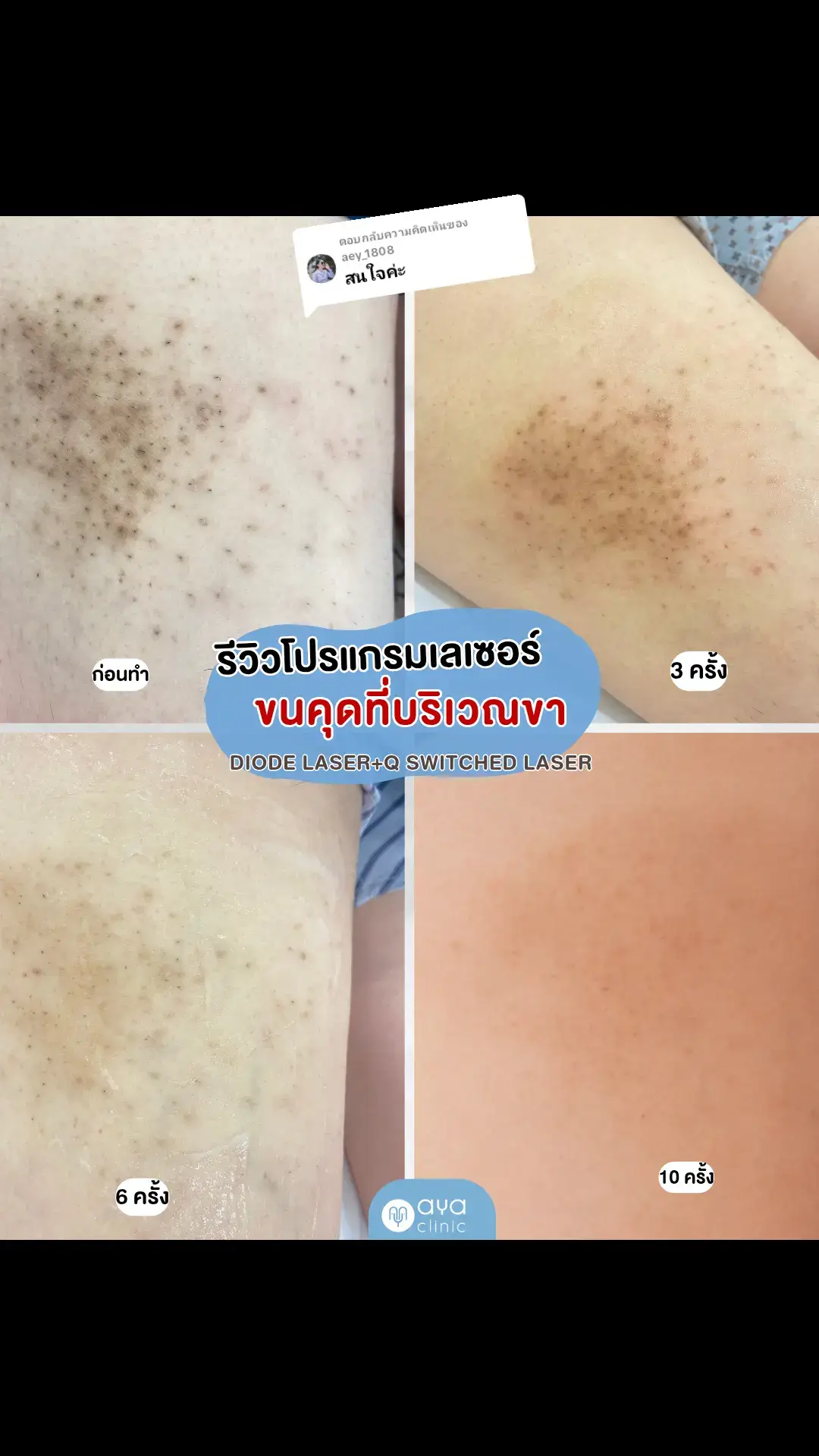ตอบกลับ @aey_1808  รีวิวการรักษาขนคุด คุณหมอแนะนำการทำเลเซอร์กำจัดขนแบบถาวรและเลเซอร์ลดรอยดำควบคู่กันเพื่อแก้ปัญหาขนคุดในระยะยาว #ขนคุด #รักษาขนคุด #รักษาขนคุดที่แขน #ไดโอดเลเซอร์ #ไดโอดกําจัดขน #เลเซอร์ขนคุด 