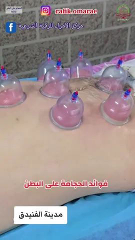 فوائد الحجامة على البطن#trend #ترند #اكسبلور #share #sports #العراق #السعودية 