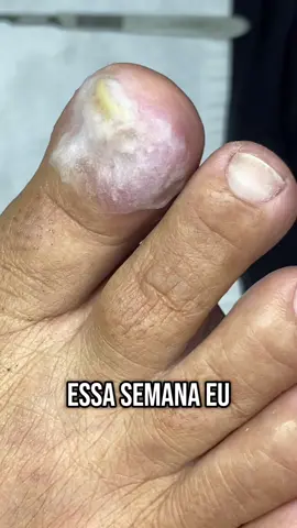 #unhasencravadas #podologia #fyppppppppppppppppppppppp #fyp 