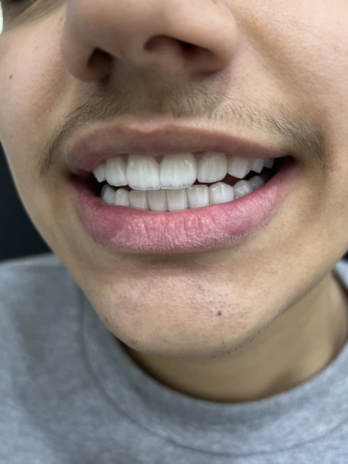 Avoir peur… des appréhensions ou même des doutes en choisissant un autre pays pour un traitement tel que des facettes est… totalement normal 😁 Notre équipe est là pour vous accompagner et vous acceuilir ✨ Peu importe d’où vous venez, vous méritez tous un service impeccable et un sourire de star 😁 Pour tout devis ou questions, veuillez nous contacter via le lien en bio 🔗 ou en MP 💬 #Nou#NousExportonsDesSouriresc#facettesn#veneersn#veneersdubain#dentalveneersc#facettesdentaireu#sourireei#meilleurcliniquedentairec#facettesdubaiac#facettesceramiquesa#Emaxa#beautéol#hollywoodsmiler#zirconfacettec#facettese#quefaireadubait#activitédubaio#chocolatdedubaic#vacancedubaic#facettesdubaiو#قشورتجميليةn#dentasmartE#WeExportSmilesn#veneersn#veneersdubain#dentalveneerssmi#smilemakeovers#bestdentalclinicb#dubaiveneerscer#ceramicveneersa#Emaxveneersa#beautyhol#hollywoodsmiler#zirconveneersn#veneersdubaithi#thingstodoindubaib#dubaiactivitiesb#dubaitreatsdub#dubaiholidayb#dubaismiles#cosmeticdentistrydubaiصد#نصدر_الابتساماتو#قشور_تجميليةن#فينيرز_دبيت#ابتسامة_هوليود#عدس#عدسات_الاسنانت#ابتسامة_جميلةض#افضل_عيادة_اسنان#فين#فينير_سيراميكن#فينير_ايماكسا#جمال#فين#فينير_زيركونت#ابتسامة_مثاليةن#فينيرز#ماذ#ماذا_تفعل_في_دبيش#انشطة_دبيو#حلويات_دبي#عطل#عطلة_في_دبيت#ابتسامتك_في_دبي #طب_الأسنان_التجميلي 