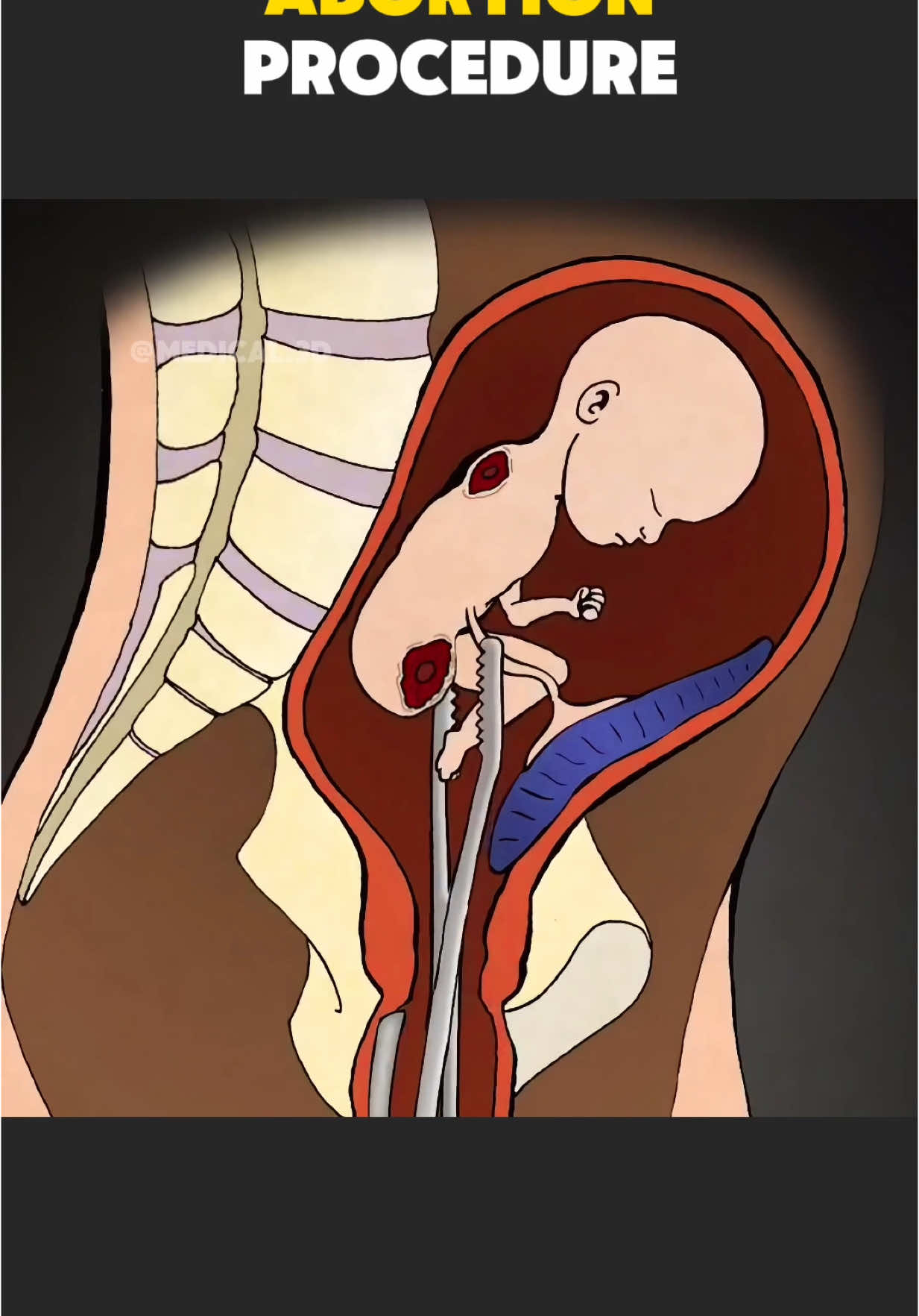 What Happens During An Abbortion? (3D Animation) #abortion #abortionprocess #birth #dilationandcurettage #abortionbaby #babyabortion #medical3danimation #3dmedicalanimation 