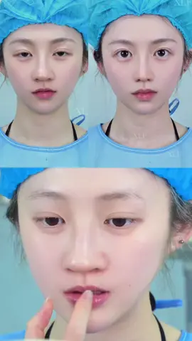 Come take a look and shorten your nose#BeforeAndAfter #rhinoplasty #nosesurgery #NoseSurgery 