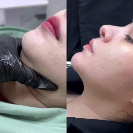Kỹ thuật xoá tan nọng kết hợp săn chắc da tại cơ sở nhà T . Trả kết quả sau 2 tuần 💉