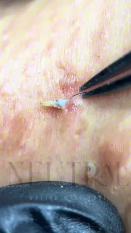 We love extractions & we love Jeleel 😆 #foryou #fypシ #extractionsatisfaciton #ingrownhairremoval #viral #jeleel #satisfyingvideos 