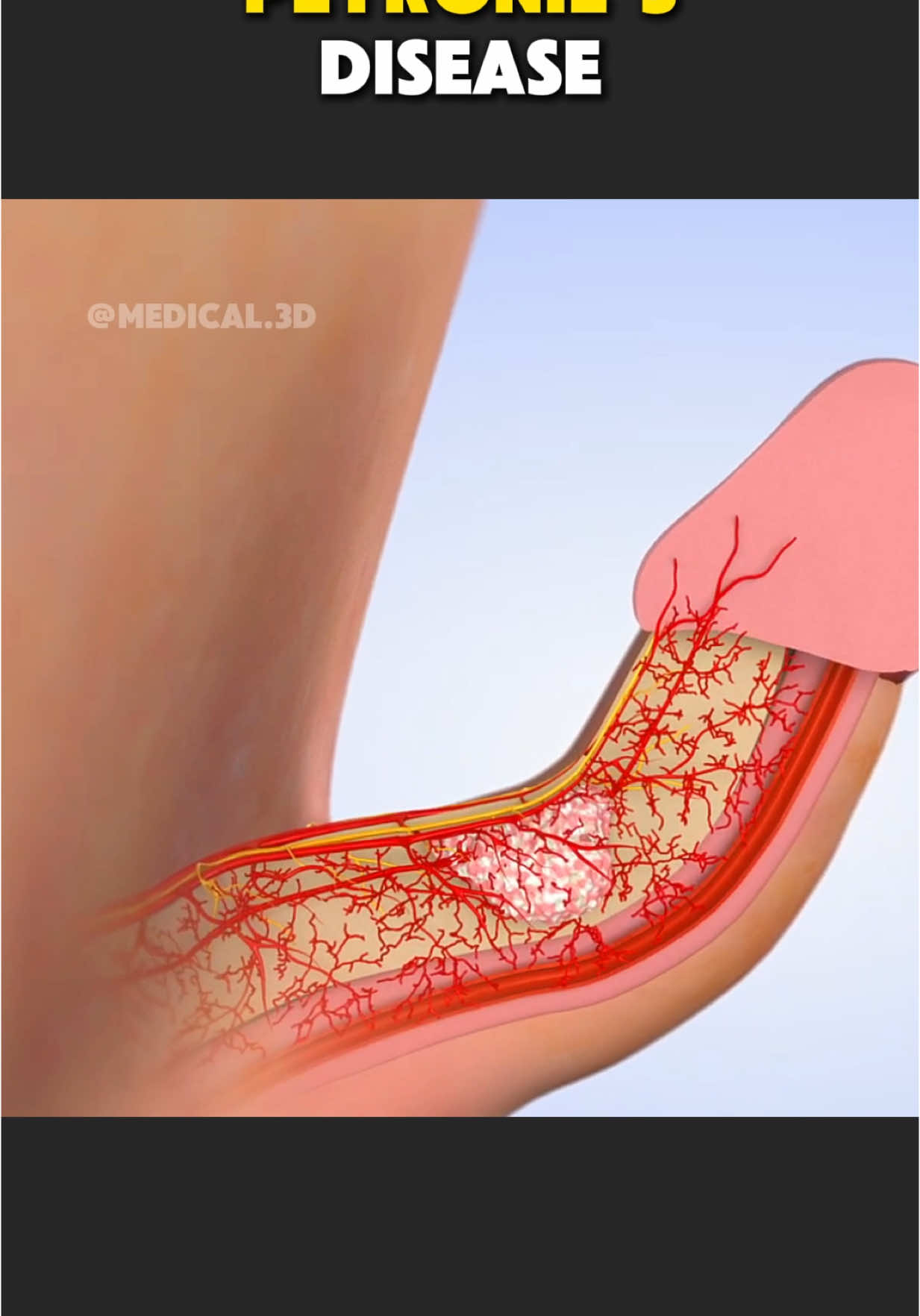 Peyronie’s Disease and its treatment (3D Animation) #peyroniesdisease #peyronie #peyroniestreatment #peyroniesawareness #shockwavetherapy #medical3danimation #3dmedicalanimation 