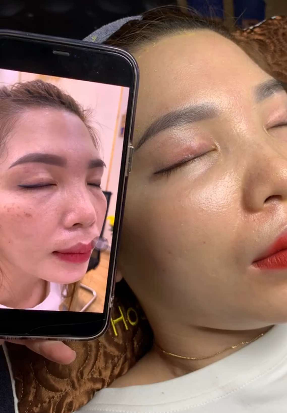 Cập nhập nám của khách #chamsocdaseo#chamsocda#chamsocdamun#chamsocdanam#tanbinh#govap 